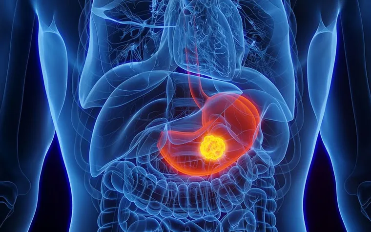 Understanding Stomach Cancer: Early Warning Signs, Symptoms, and When to Seek Help