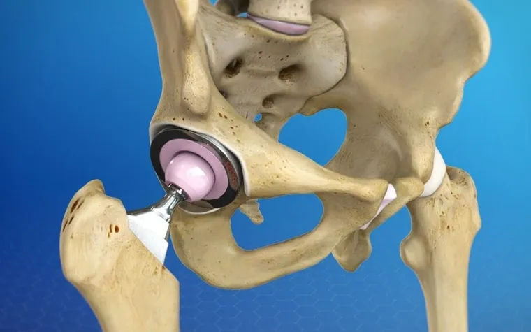 Hip Replacement: Restoring Mobility and Relieving Pain with Modern Surgical Solutions